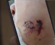女子被巨犬咬伤半张脸 狗主人却说女子碰瓷