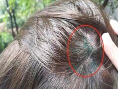 女子染发头皮变绿 理发店老板说是正常情况