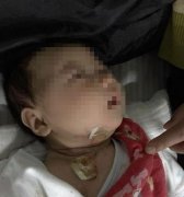 葱头煎开水能治鼻塞？妈妈相信偏方竟烫伤两月大宝宝