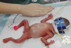 重庆一袖珍婴儿平安出院 出生仅巴掌大皮肤薄如蝉翼