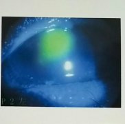 三年不取隐形眼镜 真是懒到快失明