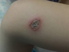 小孩放学回家后发现手臂被烫伤 伤口有一个硬币那么大