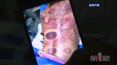 学习拔火罐遭遇烧伤 美容学院建议司法解决