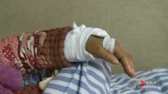 起身后凳子被端走 女子坐空左手骨折