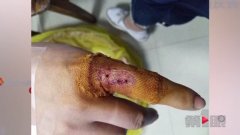 女游客住进酒店准备洗澡 浴室玻璃突然炸裂