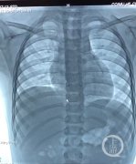 险！3岁白血病患儿体内导管破裂进入心脏