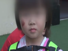 女童幼儿园里被抓伤脸 致双方家长扭打一老太被打晕